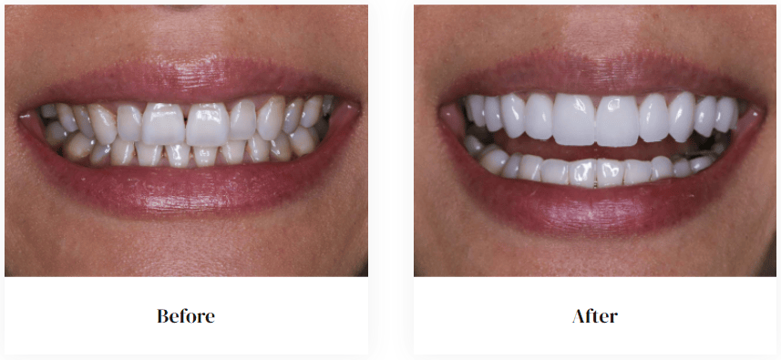 before and after