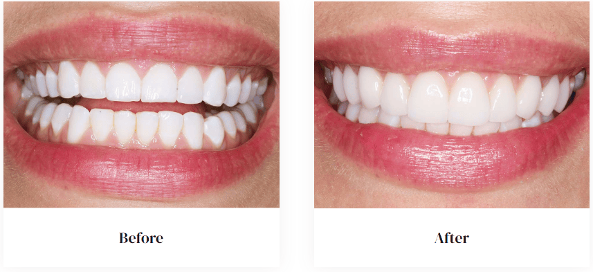 before and after