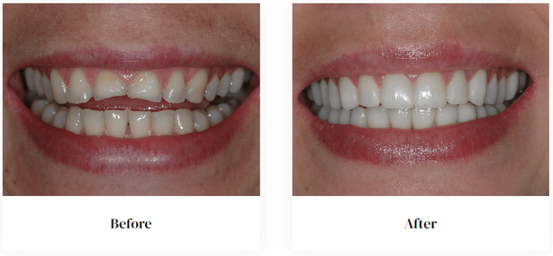 before and after
