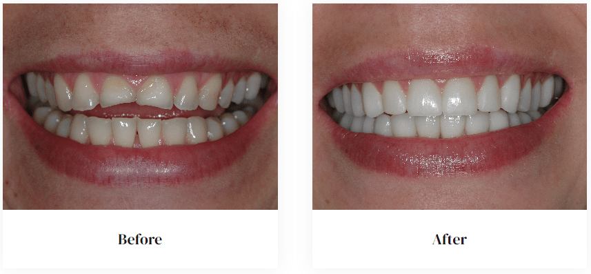 before and after
