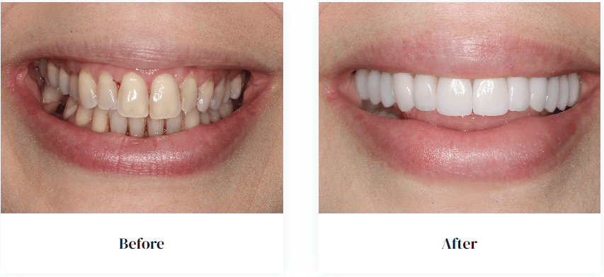 before and after