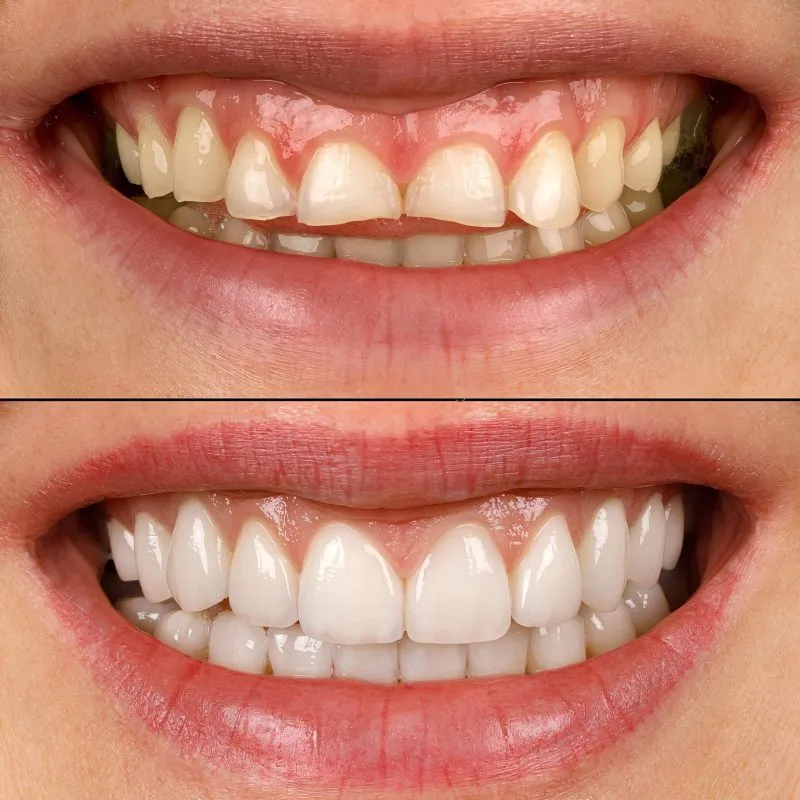 Before and after for no prep veneers