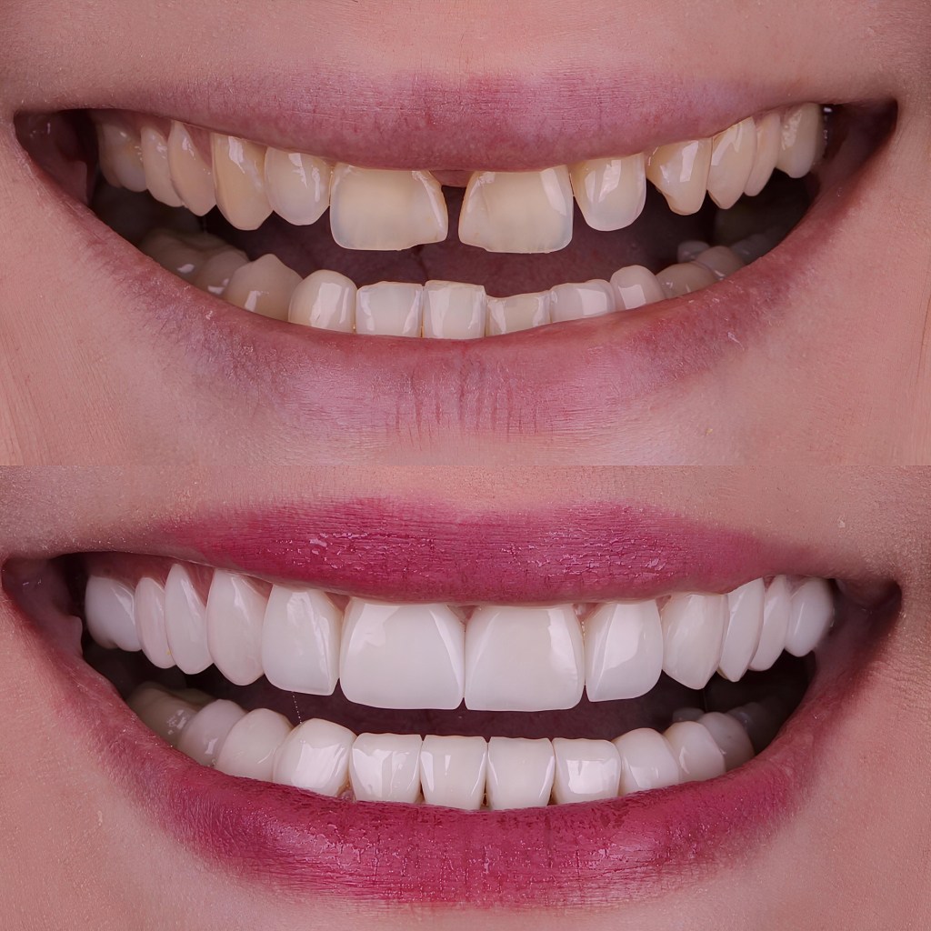 Before and after for smile makeover