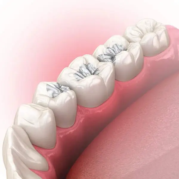 3D Rendering of Mercury Fillings