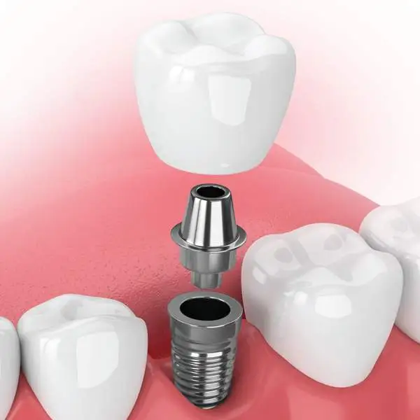 3D Rendering of a Dental Implant