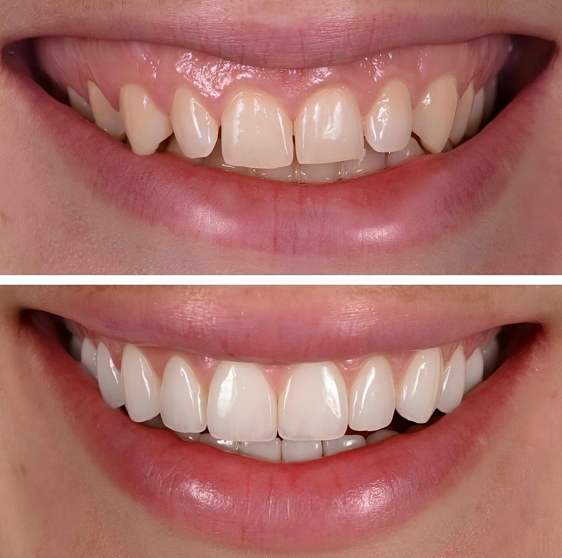 veneer before and after