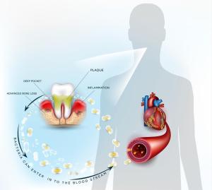 Gum disease bacteria entering the bloodstream